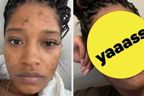 Keke Palmer Shared How To “Cure” Adult Acne, But It’s Not Worth It Unless You Want A Baby