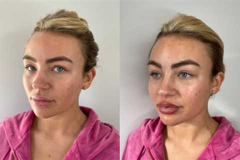 Towie’s Ella Rae Wise shows off results of her £600 lipstick tattoo after getting lip filler..