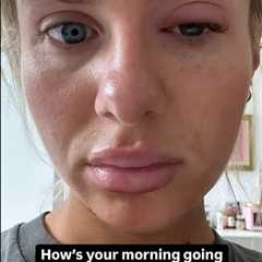 Chloe Burrows' Eye Condition Prompts Concern Among Fans: A Deeper Look