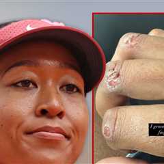 Naomi Osaka Shows Off Gnarly Blisters, Opens Up On Wanting Tennis Break