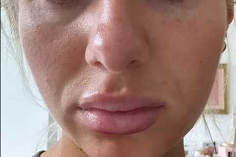 Chloe Burrows' Eye Condition Prompts Concern Among Fans: A Deeper Look