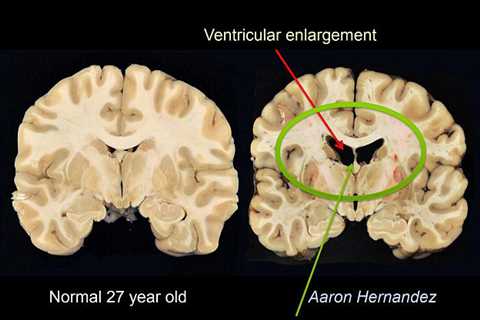 What is CTE? The neurodegenerative disease NYC gunman Shane Tamura claimed to have