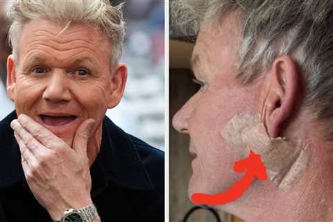 Gordon Ramsay Just Shared Photos Of His Scar After He Underwent Treatment To Remove Skin Cancer