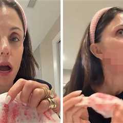 Bethenny Frankel Bleeds After Cutting Her Face With Skin Product on Video