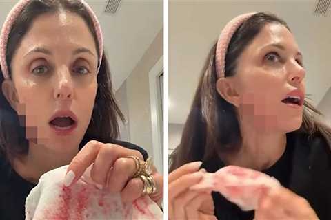 Bethenny Frankel Bleeds After Cutting Her Face With Skin Product on Video
