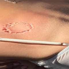 Horrific new photo shows extent of Puka Nacua bite victim’s alleged injury