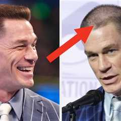 After Breaking Down The Intense Details Of His Back-To-Back Hair Transplants, People Are Stunned By ..