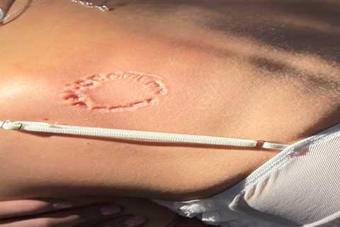 Horrific new photo shows extent of Puka Nacua bite victim’s alleged injury